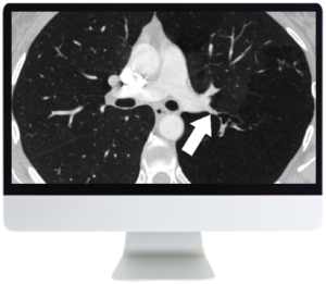 ARRS basic chest imaging