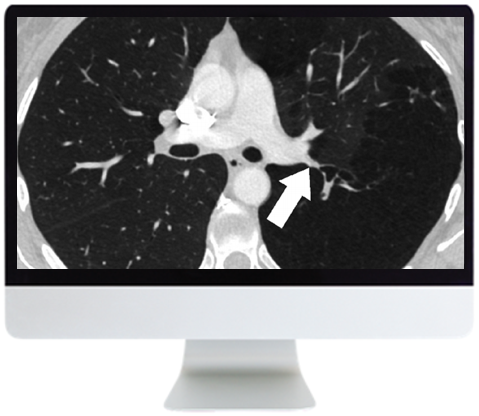 ARRS basic chest imaging