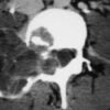 degenerative joint disease MRI mastery