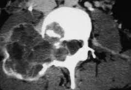 degenerative joint disease MRI mastery