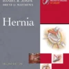 Hernia Surgery Textbook, 2th Edition