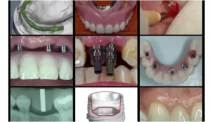 A-z in Restorative Implant Dentistry Series