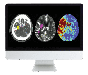 Code Stroke Radiology Course | ARRS 2022