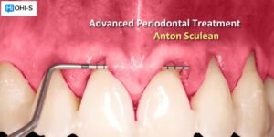 OHI-S Advanced Periodontal Treatment Course