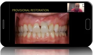 Soft Tissue Management Around Dental Implants