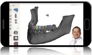 Advanced Implant Planning