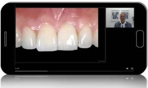Surgical Extrusion and Replantation of Teeth