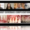 Mucogingival surgery: root coverage protocols 2.0