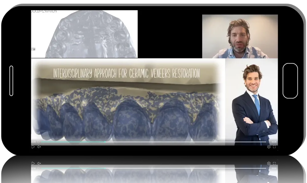 Modern Ceramic Veneers in Comprehensive Care: Current Guidelines and Team-Based Planning