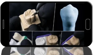 Sculpting Natural-Looking Teeth for Beauty and Function: Observe, Carve, Perfect