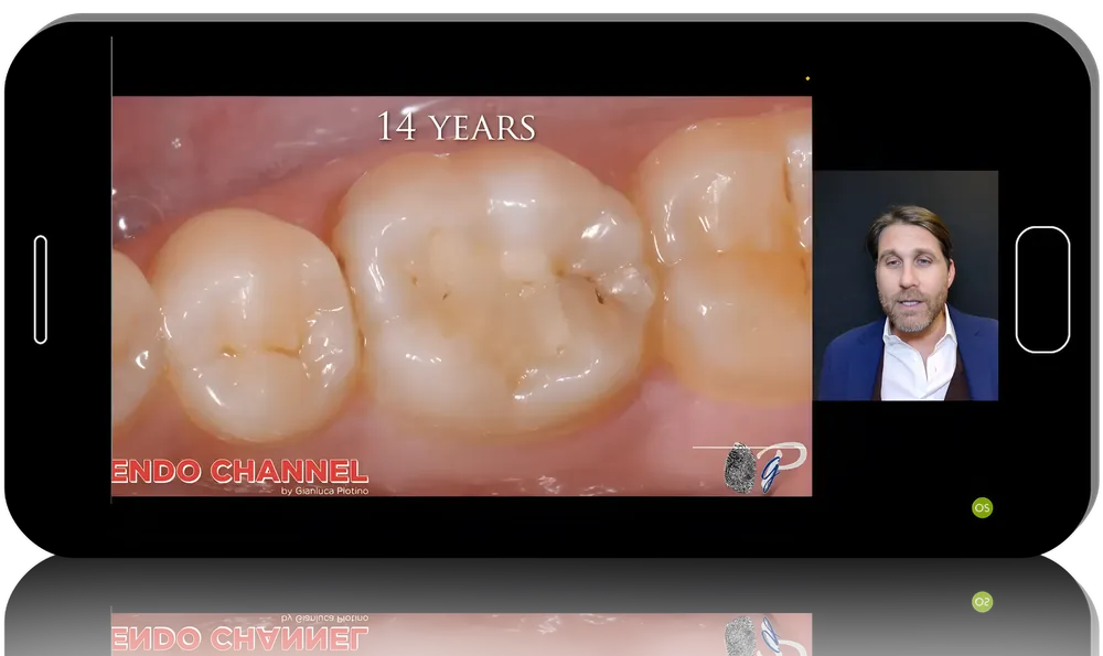 Endodontic Retreatment