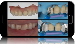 Mastery Academy Veneer Preparation and Administration