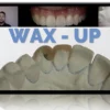 Injectable Technique: Composites Veneers, Comprehensive Online MasterClass 2022