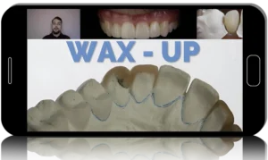 Injectable Technique: Composites Veneers, Comprehensive Online MasterClass 2022