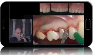 Osseous Resective Surgery