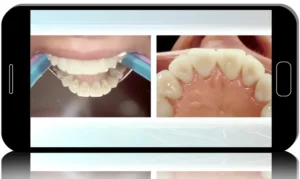 Mastering Smile Framing: Gingival Esthetics, Biologic Width, and Restorative Synergy
