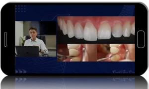 Composite Resin in Anterior and Posterior Teeth
