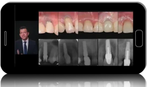 From Extraction to Implant: Evidence-Based Ridge Preservation