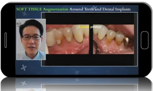 Soft Tissue Augmentation around Teeth and Dental Implants