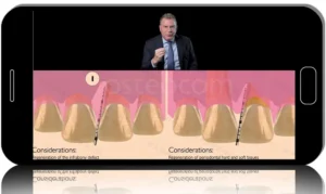 Coronally Advanced Entire Papilla Preservation Technique