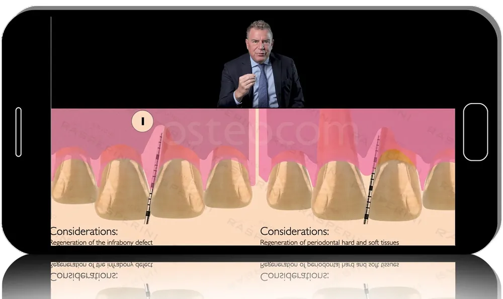 Coronally Advanced Entire Papilla Preservation Technique