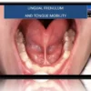 How Sleep Bruxism Leads to Implant Failure