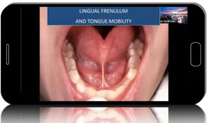 How Sleep Bruxism Leads to Implant Failure