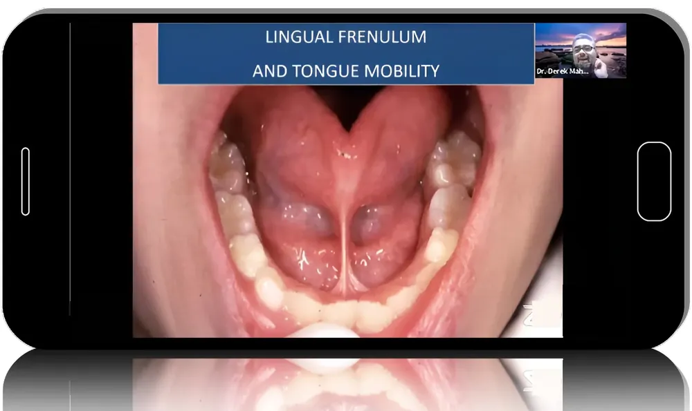 How Sleep Bruxism Leads to Implant Failure