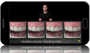 Unfolding Peri-Implantitis