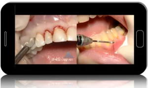 Hard and Soft Tissue Ridge Augmentation and Esthetic Crown Lengthening