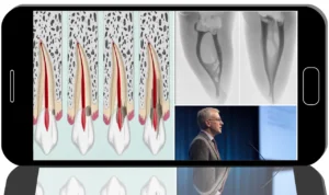 Online endodontics intensive: modern tools, materials, and protocols
