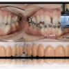 Treating the Worn Dentition
