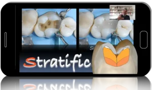 The Easier and Modern Approach for Direct Composite Restorations in Posterior Teeth