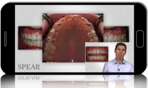Predictable Dentistry Through Occlusal Stability