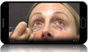 Lower Blepharoplasty With Fat Transposition and Adjuncts 2026