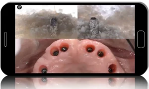 Implant Aesthetics, How to Select Connections and Digital Solution