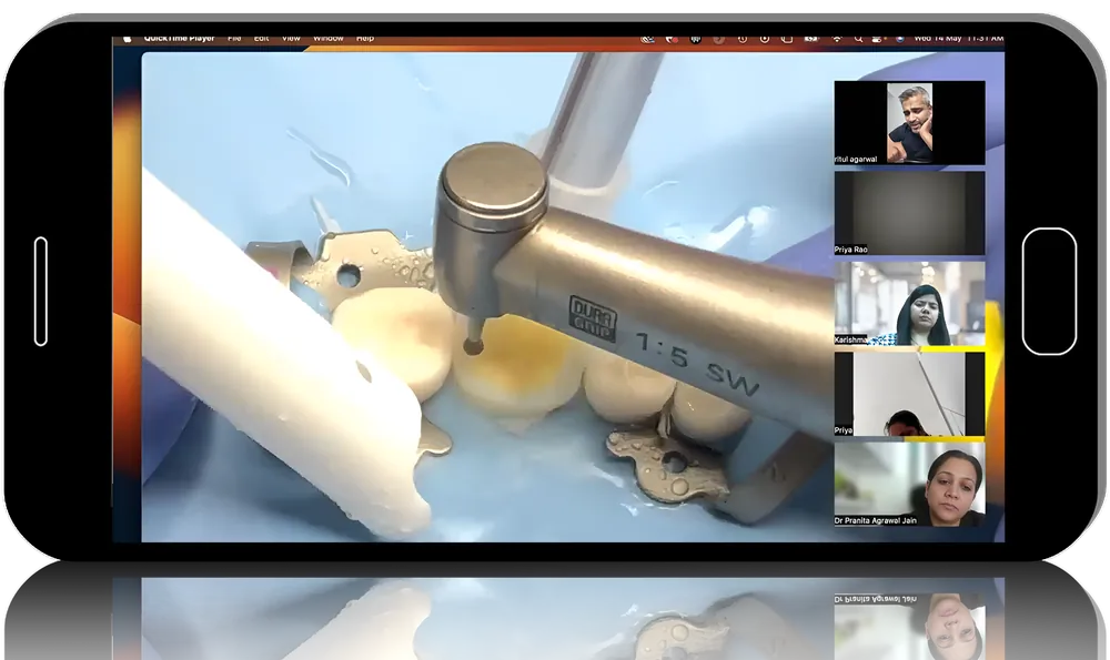 Posterior Partial Bonded Restorations and Adhesion in Dentistry