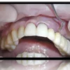 Key Surgical and Prosthetic Considerations for Soft Tissue Management in Immediate and Delayed Implantology
