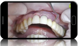 Key Surgical and Prosthetic Considerations for Soft Tissue Management in Immediate and Delayed Implantology