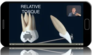 All About Torques In Orthodontics