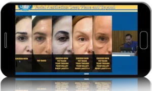 Facial Aesthetics Deep Plane and Beyond 2025