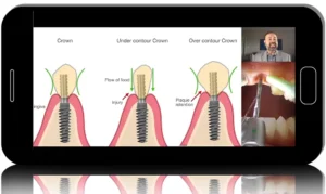 Emergence Profile Creation. Biologically Driven Implantology