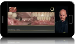 Biological Bone Augmentation