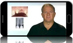 Ridge, Pontics & Papilla: Esthetic Strategies