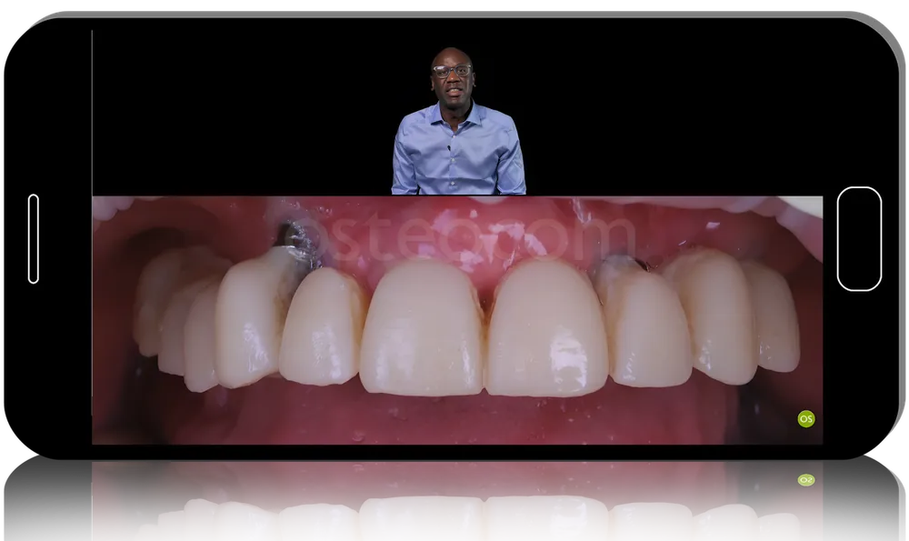 FP1 - Full Arch Rehabilitation: Step-by-Step Procedure