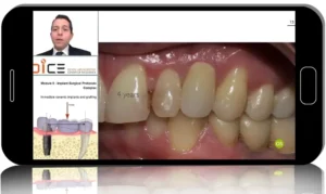 Full-Scope Zirconia Implantology: Surgical & Prosthetic Protocols