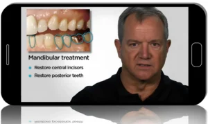 SPEAR Classic Collection. Precision Esthetics: Mastering Single Tooth Anterior Implants