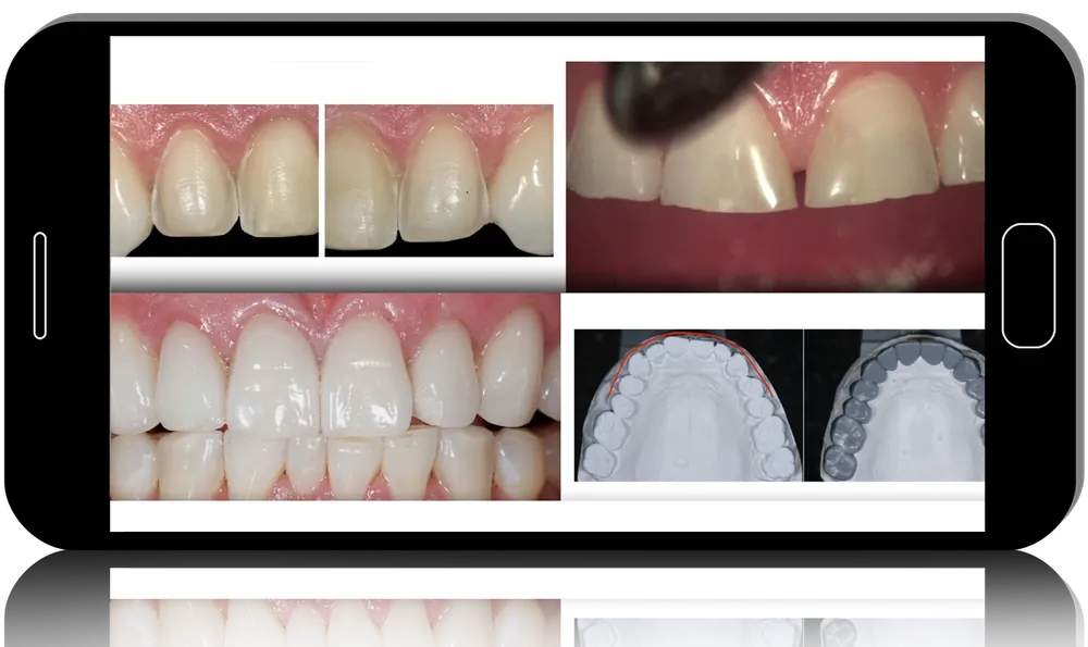 Porcelain Veneer Precision, Comprehensive Training for Porcelain Veneer Cases