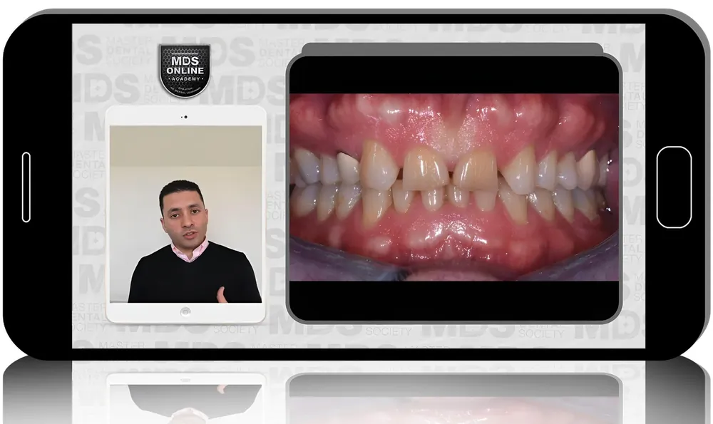 Laminate Veneers+Live Demo