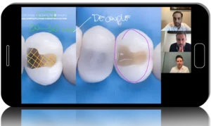 Contact point: effective posterior teeth direct restoration technique